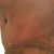 Scar @ 4 wks (left side).
