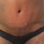 Scar @ 4wks (front).  My left hip is larger than the right side.  PS said she will correct it if it does not go down by the 4th or 6th month.  She says I am still pretty swollen.