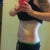 one week post op