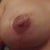 front view right breast 4wks