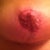Right Nipple. 8 weeks post op. (4 weeks after necrotic tissue removed from areola)