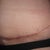 5 week's post-op started smoken again and this is what i get sham on me i know