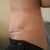 Left side 2week post op. swollen still but getting better.