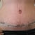 Front view. 2 week post op. Swollen but getting better every day.