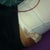 A bit of brusing-day after surgery