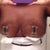 My breasts look beat up, but they are smaller and standing upright! Day 3 post op