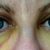 Day 7 - not a lot of change from yesterday. Bit less yellow and the right eyelid doesn't feel swollen anymore.