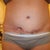 8 month's post pot as you can see my open wound has closed up and healed and in 2 months i get to go in for my SRS woo hoo