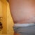 8 month's post pot as you can see my open wound has closed up and healed and in 2 months i get to go in for my SRS woo hoo