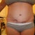 8 month's post pot as you can see my open wound has closed up and healed and in 2 months i get to go in for my SRS woo hoo