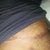 incision, can you see the ugly vertical scar