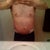 After (4 weeks post-op)