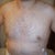 After -front (1 day post-op)