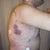 After -side (1 day post-op)