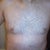 After -front (4 days post-op)