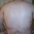 After -back (4 days post-op)