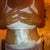 Day 4 Post Op - dressing is still on and I'm swollen but you can see the difference and best of all No Drains!