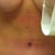 Close up of scar. Stretch mark is the white thing above vertical t. Bandaid covers spitting stitch. I'm happy with it - very straight and low!  6 weeks, 2 days