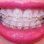 5-6 week follow-up with new wire.  Front teeth are still sitting on neighboring teeth.