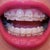 5-6 week follow-up with new wires.  Right bottom teeth are being pull to the right.  I am worried about the right pull.