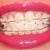 5-6 week follow-up.  From a slight distance people say your teeth are beautiful and already straight. Why braces?