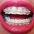 5-6 week follow-up and new wires are pulling teeth in many directions.