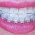 5-6 week follow-up and new wires look so greet from a distance. Smiling downward natural smile. I like how the wire is pushing my teeth down.