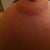 The almost non existent scar!