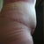 6 weeks po swelling.. The funky lines are from the garment