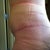 6 weeks po swelling.. The funky lines are from the garment