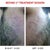 BEFORE FIRST TREATMENT SESSION