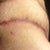 Redness of skin on my sides, still some bumps from what i can only assume are stitches still dissolving.