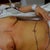 before surgery