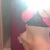My tummy line can be seen at my side, the skin stretches far beyond. I don't need any back of flank Lipo I'm lean everywhere else.