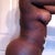 3 days post op "re touch" bbl no difference except shelf down a bit