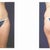 BEFORE SURGERY: Tummy / Flanks / Thighs