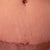 4 Week Post-Op TT incision