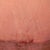 4 Week Post-Op Up Close TT incision. Little scab there, but not infected.
