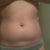 This was pre-surgery on a bloated day... (a few days prior to operation)