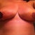 Day 5.  Right nipple has a very different color than left. Possibly a reaction to tegaderm. Looks like a layer of skin may have come off with tegaderm.  PS pricked with a needle to make sure it bled. It did, thank GOD!