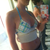 1 Day Post-Op.. Unpadded bikini
