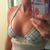 1 Day Post-Op.. Unpadded bikini