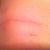 Other side of incision