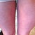 Bumps are all over my legs too :(