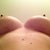 Mammary fold incisions. 2 weeks post op - breathing without steri strips.