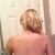 2 week post op - no more back rolls! Hallelujah!