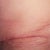Left Scar