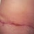 RT Scar..this one is the worst..had spitting stitches.. :(