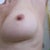 scars after stitches removed (2 weeks)