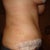 2 weeks post op right side healing faster I guess I think tummy looks good so far